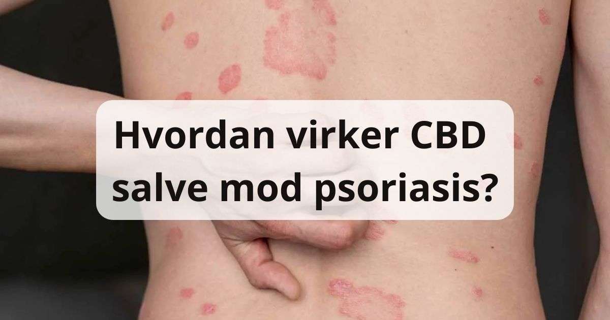 Hvordan virker CBD salve mod psoriasis?