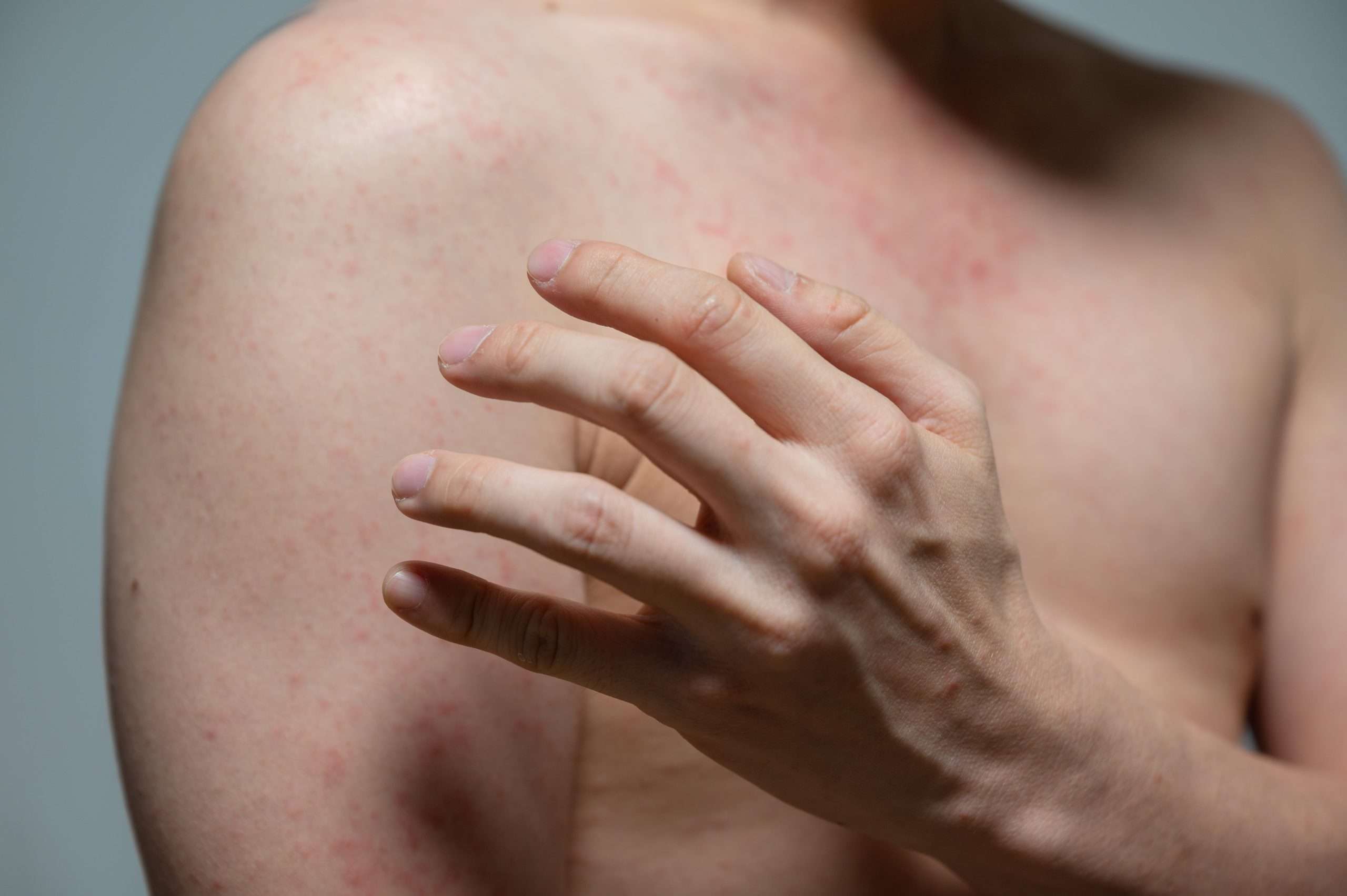 dermatitis-udslæt-viral-sygdom