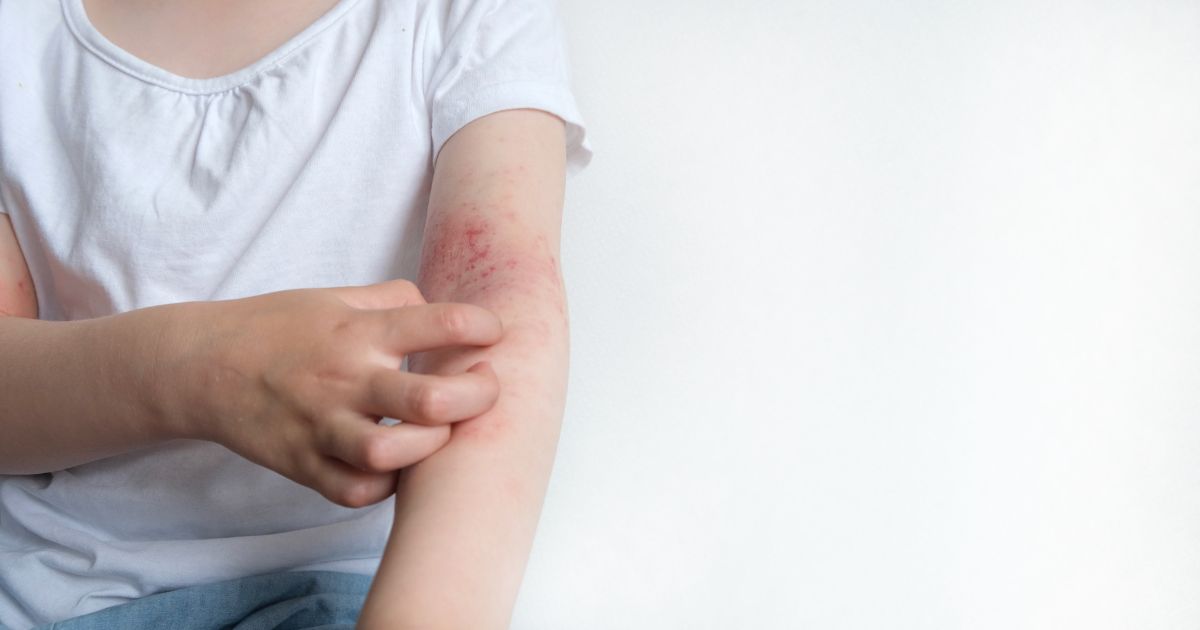 eczema